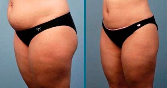metodes svara zaudēšanai par 10 kilogramiem mēnesī